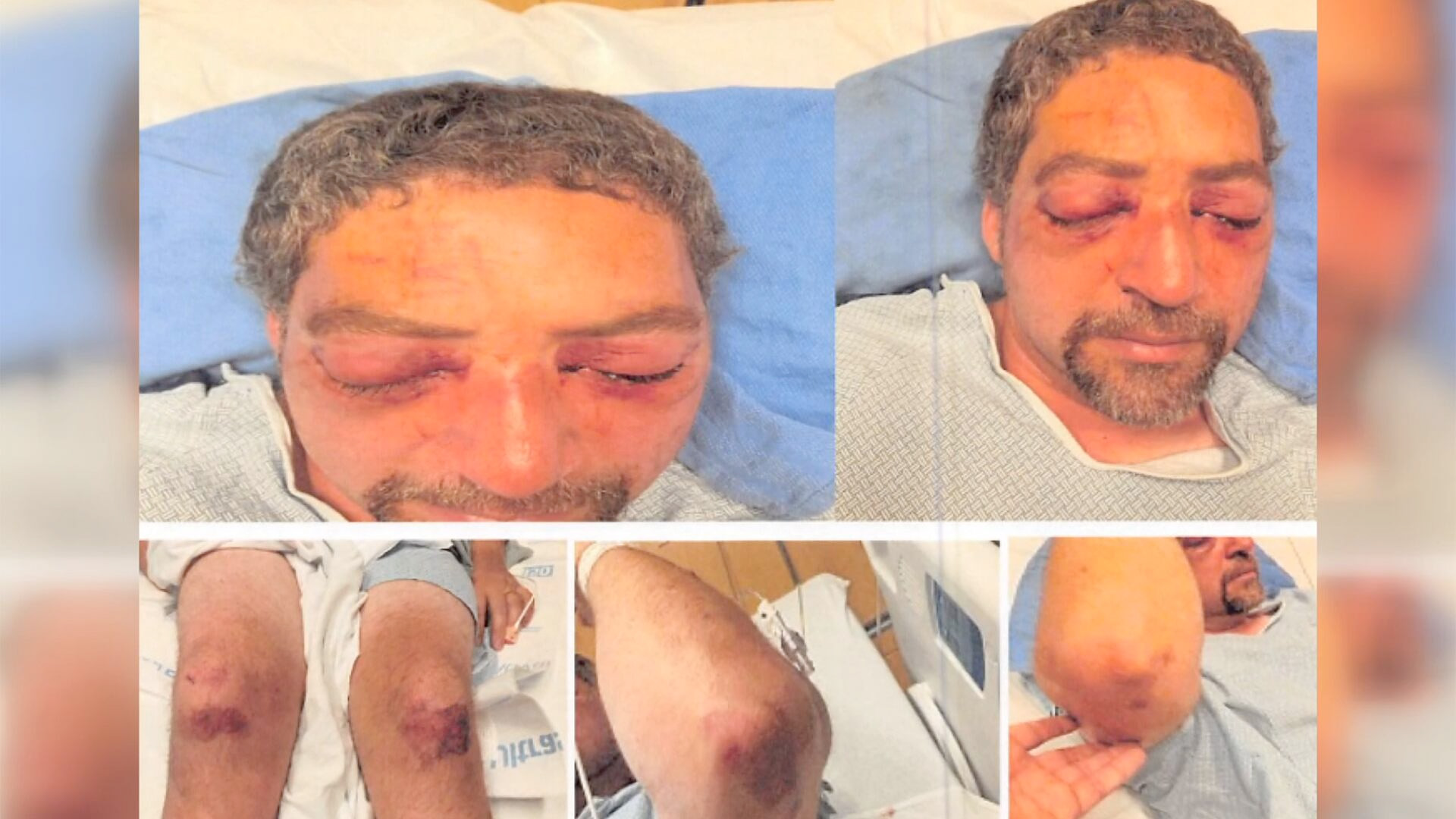 Police say Ronnie Bushway II has serious eye injuries and remains unable to see. (Courtesy: Winooski Police)